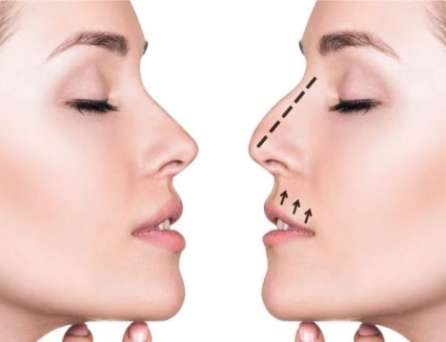 What is Arched Nose Aesthetics?